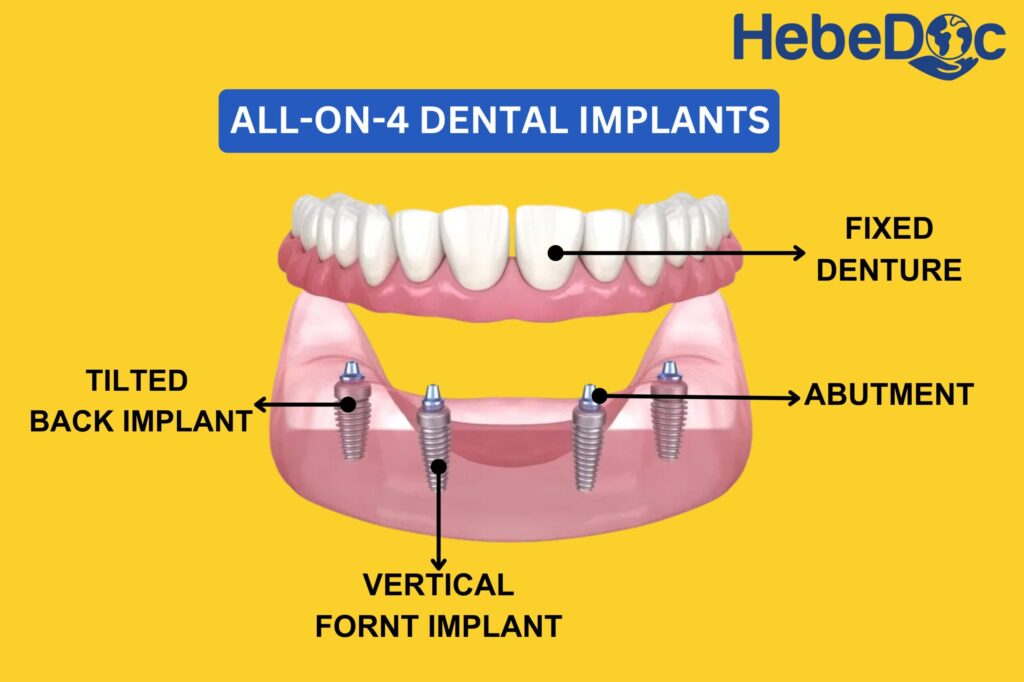 all on 4 dental implants