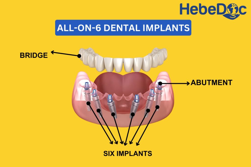 all on 6 dental implants