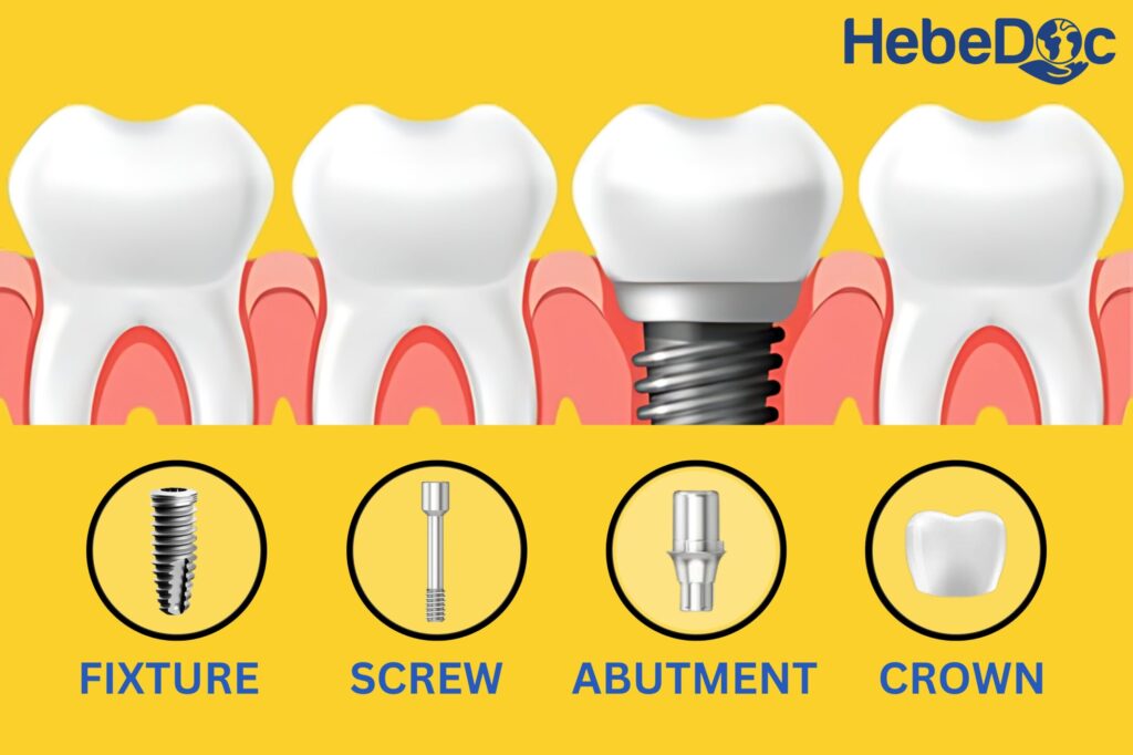 Single dental implant