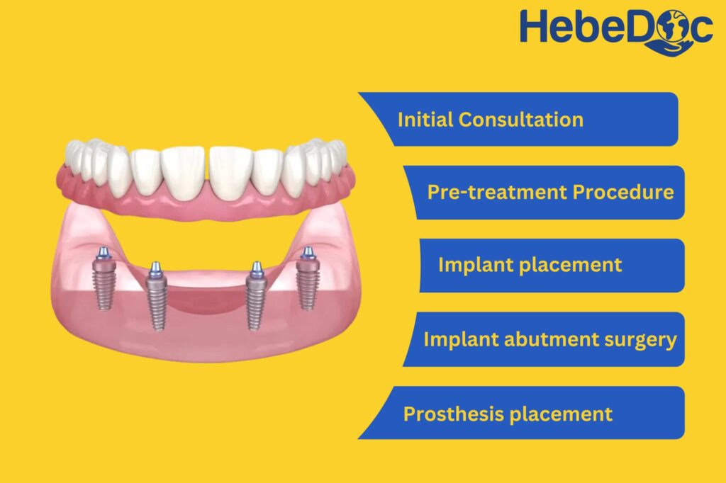 All on 4 dental implants procedure