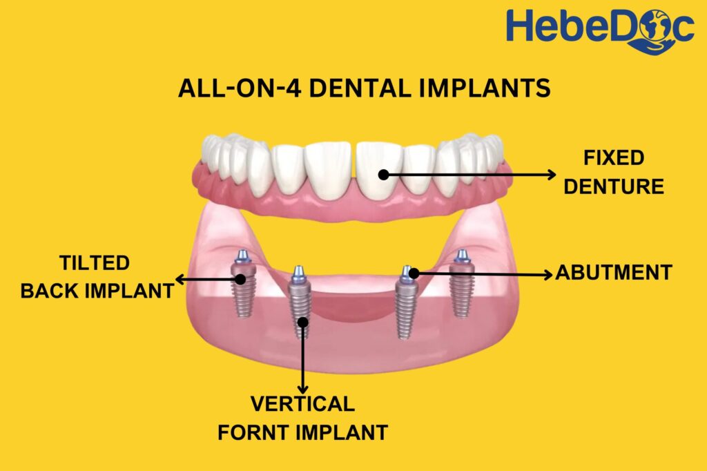 all-on-4 dental implants