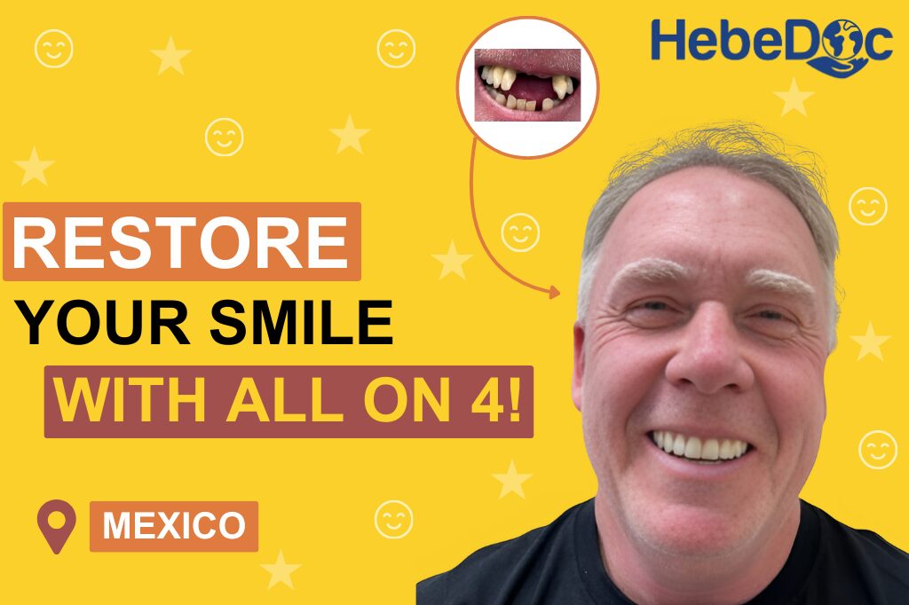 All on 4 dental implants in Mexico