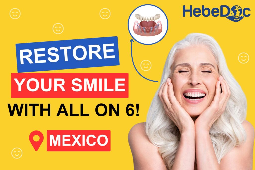 all-on-6 dental implants in Mexico