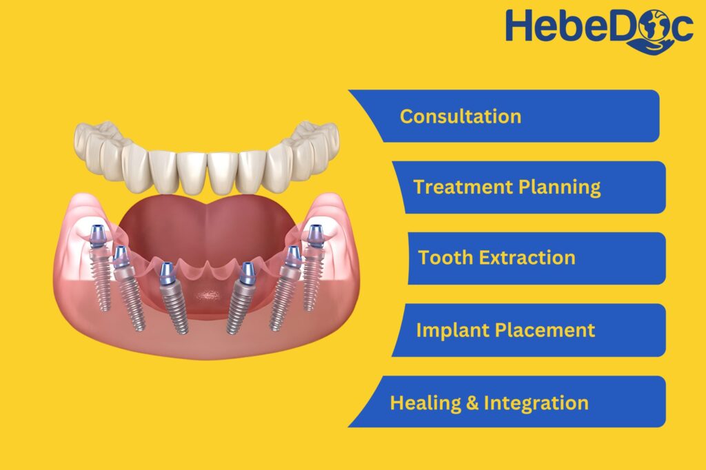 all-on-6 dental implants procedure