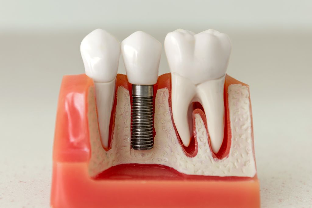 Are Dental Implants Permanent