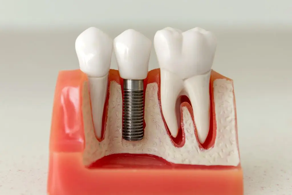 Are Dental Implants Permanent
