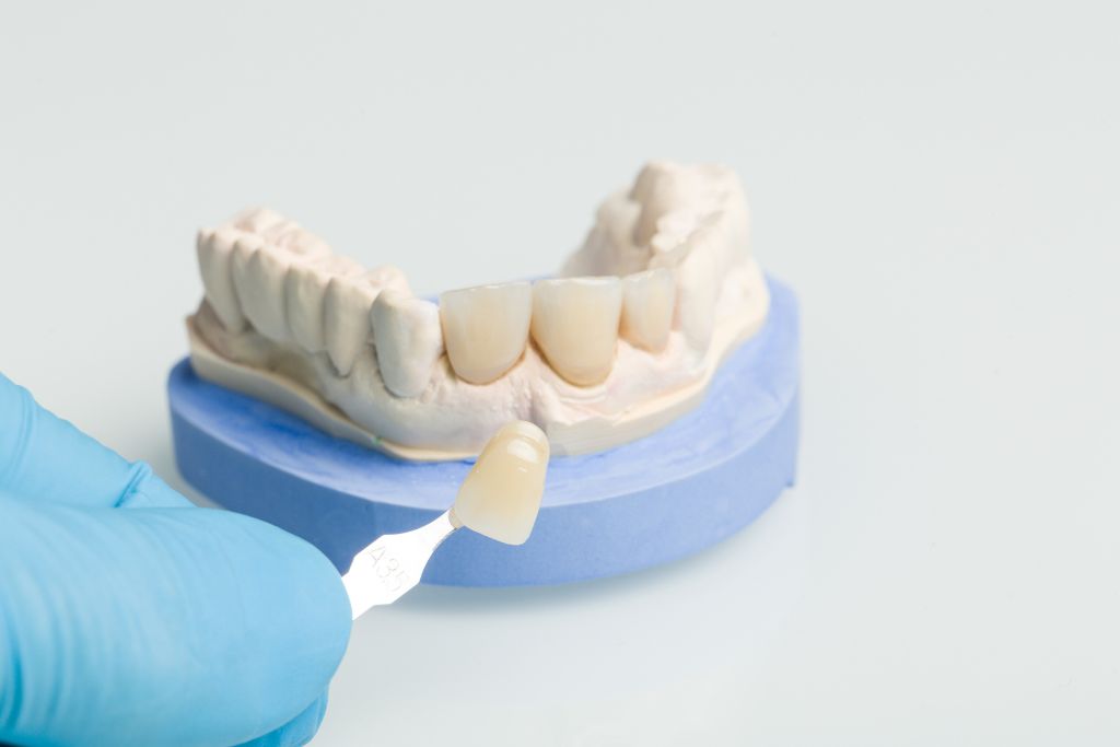 Dental Crowns Everything You Need To Know