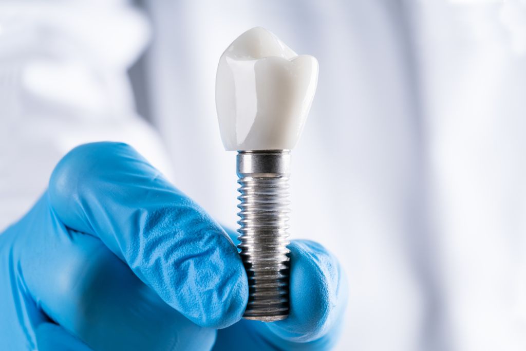 Do dental implants get cavities