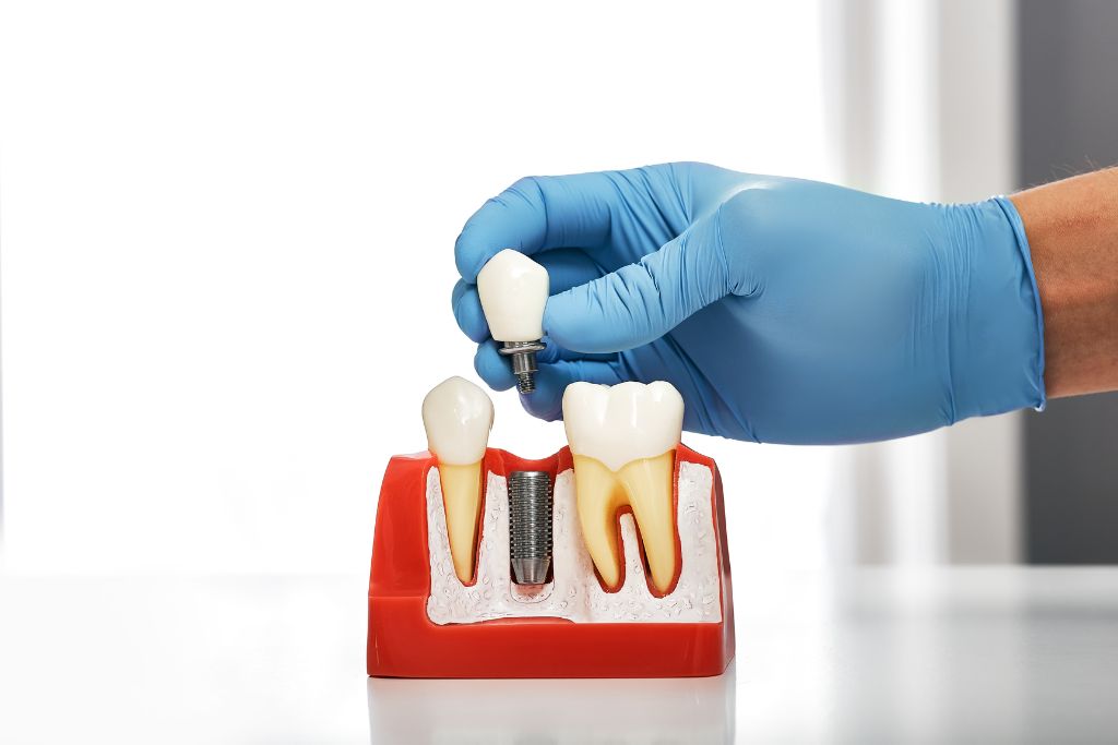 Types of dental implants