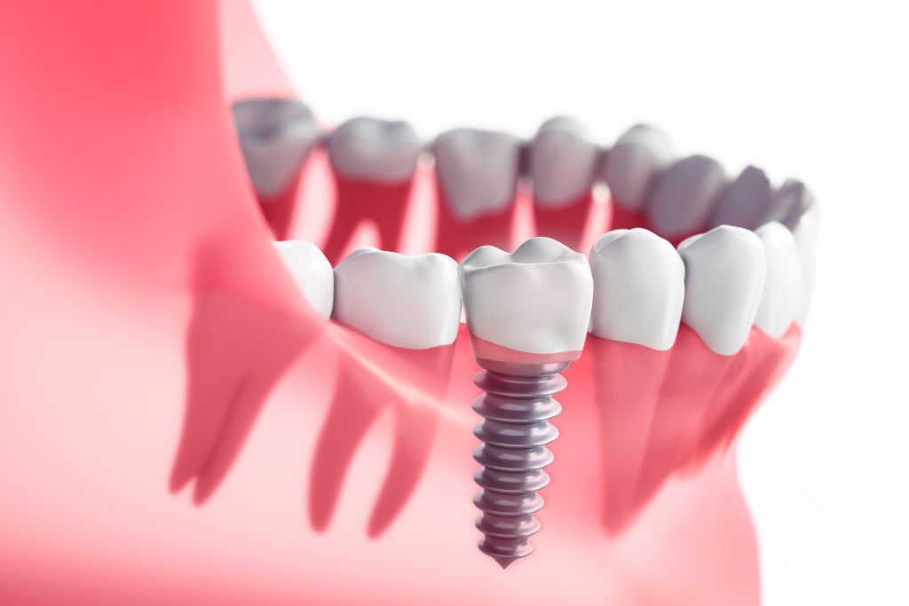 What are mini dental implants and how long do they last