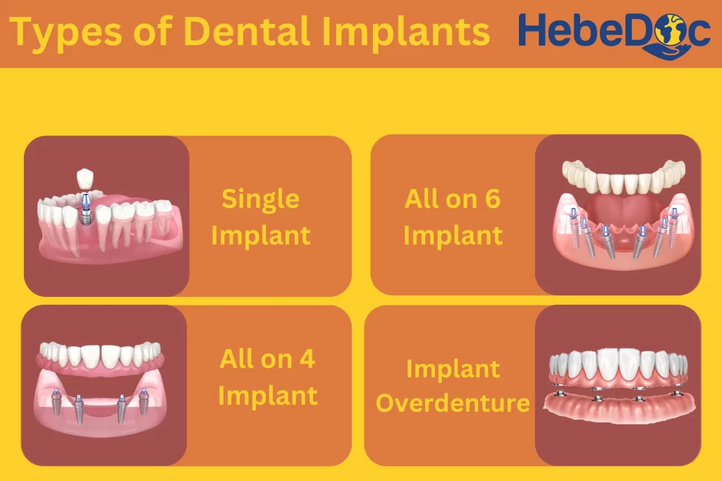 Types of dental implants in Mexico