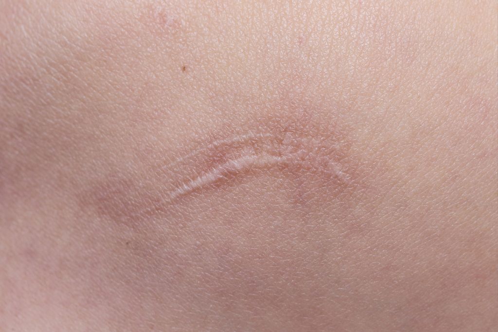 Dealing with Swelling and Bruising Post-Surgery