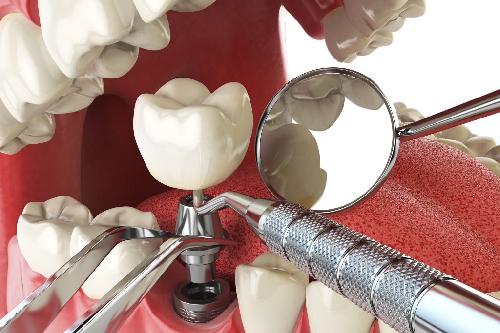 Managing Pain and Discomfort After Dental Implants