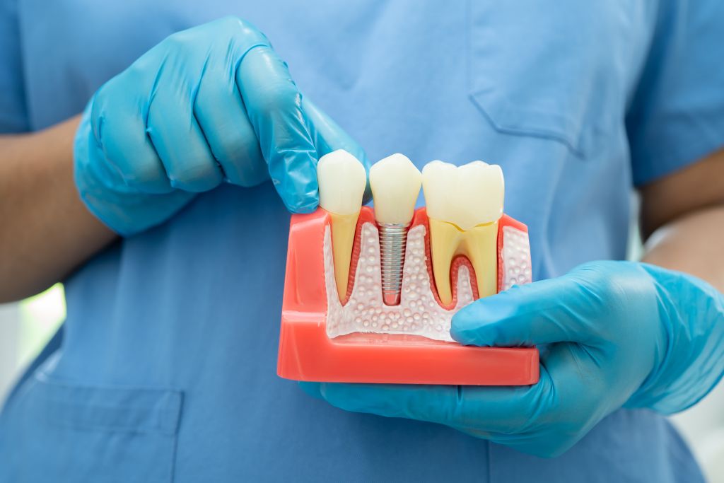 Types of Dental Implants Based on Attachment Method