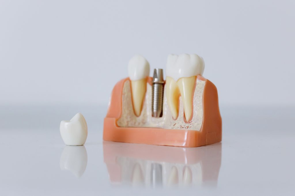 Types of Dental Implants Based on Material