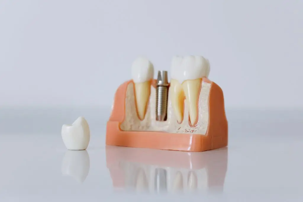 Types of Dental Implants Based on Material