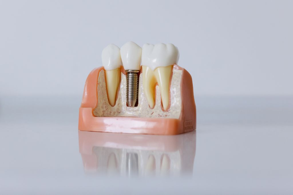 Types of Dental Implants Based on Number of Teeth Replaced