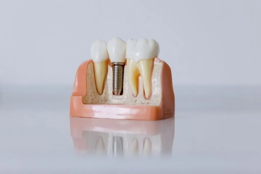 Types of Dental Implants Based on Number of Teeth Replaced