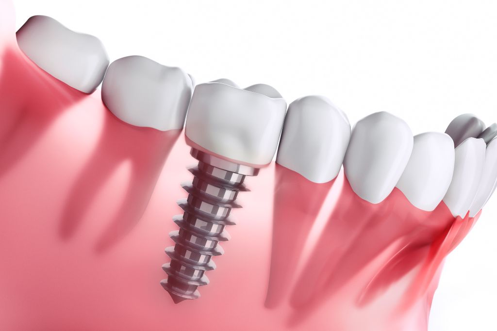 Which country offers the cheapest All-on-4 dental implants